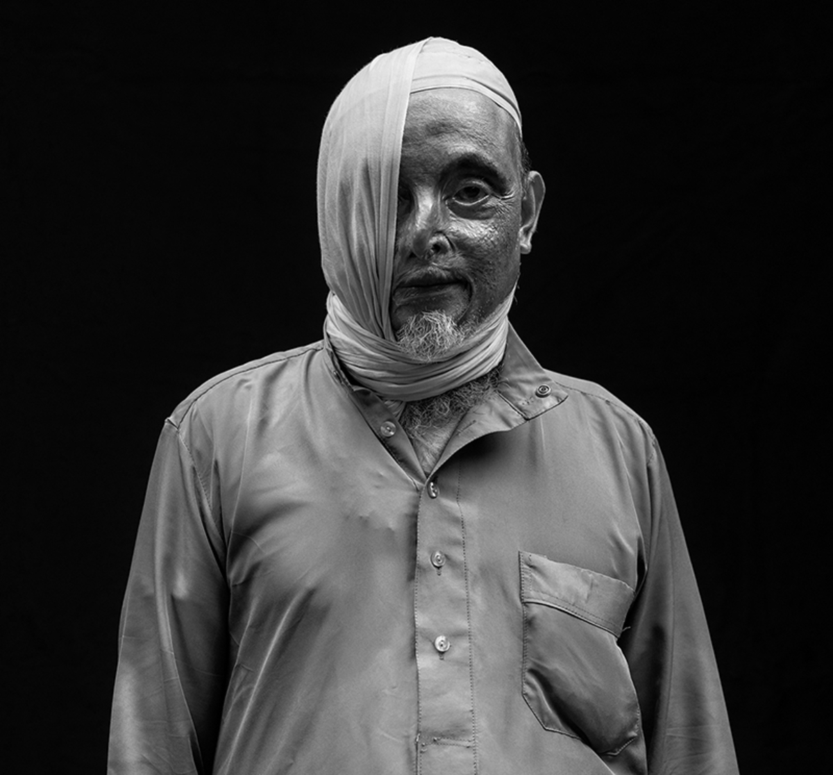 Acid attack Survivors